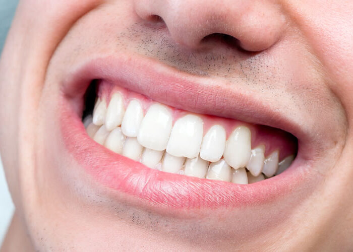 bruxismo-dental