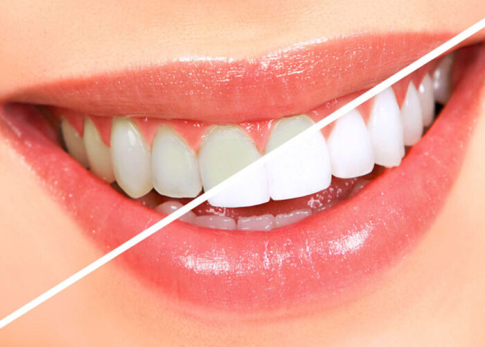 clareamento-dental