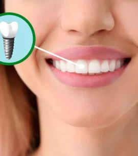implante dentario